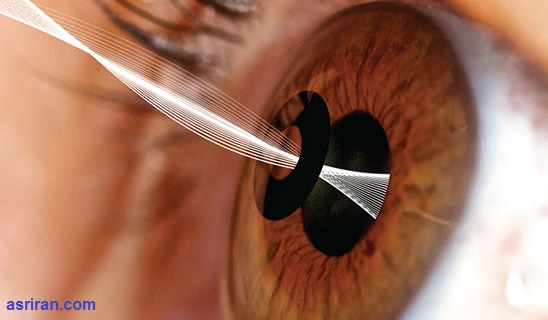 عینک مطالعهای که درون چشم کاشته میشود عینک مطالعهای که درون چشم کاشته میشود