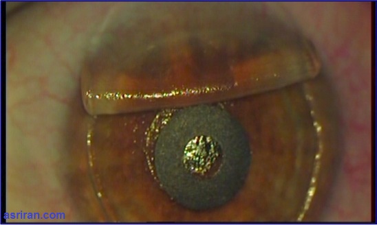 عینک مطالعهای که درون چشم کاشته میشود عینک مطالعهای که درون چشم کاشته میشود