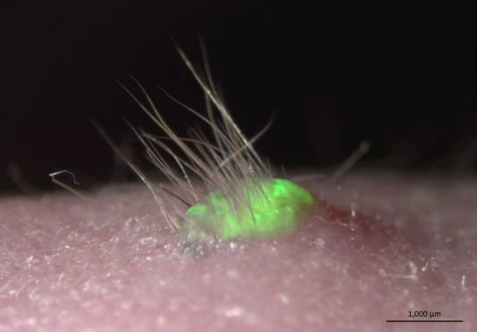 تولید پوست طبیعی برای درمان سوختگیهای شدید