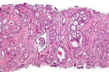 اميد تازه براي درمان سرطان هاي كشنده پروستات