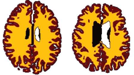 چاقی مغز را 10 سال پیرتر می کند