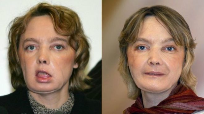 اولین دریافت کننده پیوند صورت در جهان درگذشت (+عکس)