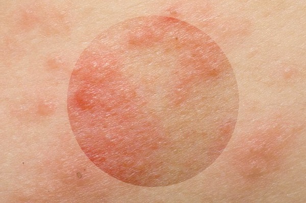 رابطه استرس و شرایط پوست