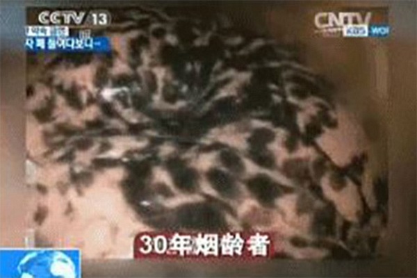 تاثیر سیگار کشیدن بر ریه&zwnj;ها به روایت تصویر