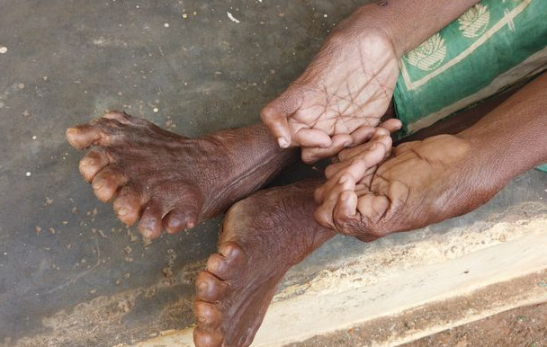 بیشترین انگشت دست و پا