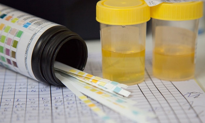 آلبومینوریا؛ وقتی پروتئین در ادرار نشت می&zwnj;کند