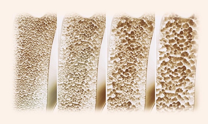 آیا امکان معکوس کردن پوکی استخوان وجود دارد؟