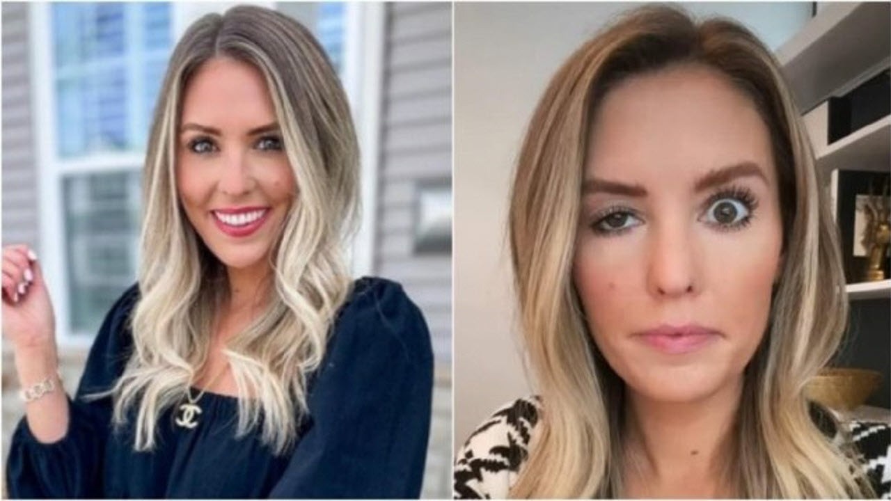 بلایی که بوتاکس بر سر یک اینفلوئنسر اینستاگرام آورد (+عکس)