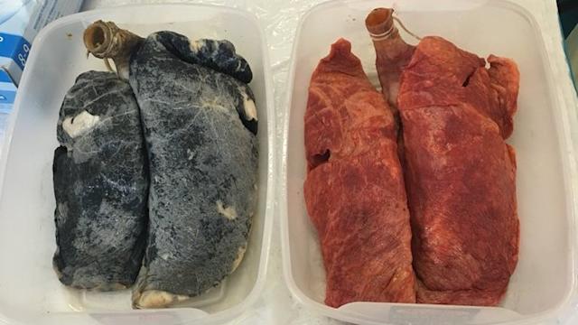 تاثیر سیگار کشیدن بر ریه&zwnj;ها به روایت تصویر