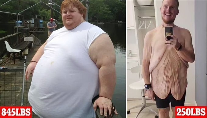 بلایی که کاهش وزن بر سر بدن جوان آمریکایی آورد + عکس