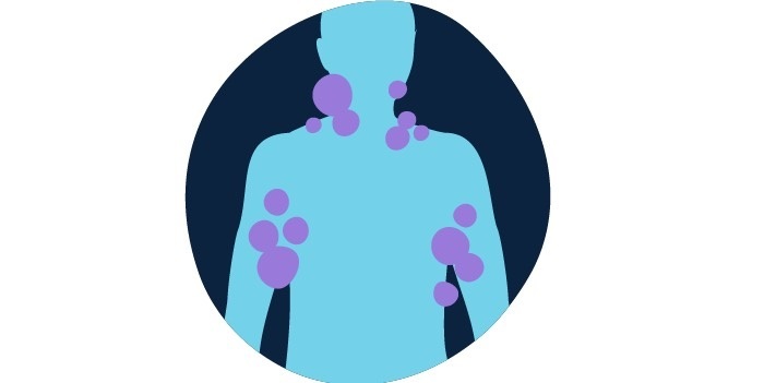 سرطان خون و همه چیز درباره نشانه های آن سرطان خون و همه چیز درباره نشانه های آن