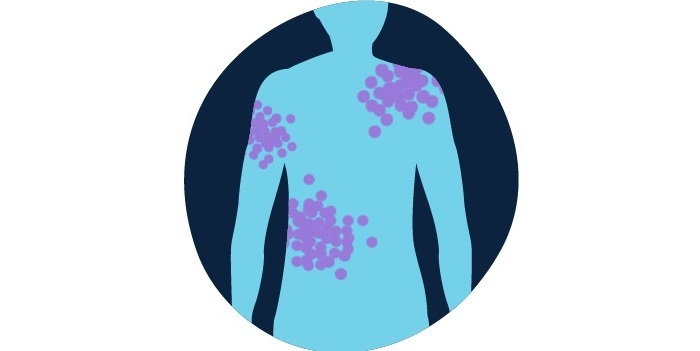 سرطان خون و همه چیز درباره نشانه های آن سرطان خون و همه چیز درباره نشانه های آن