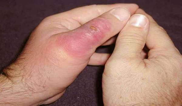 رتبه جالب عقرب گزیدگی ایران در جهان/ نیش مار و عقرب سال گذشته چند ایرانی را راهی بیمارستان کرد؟