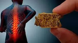 پوکی استخوان چهارمین عامل مرگ در جهان
