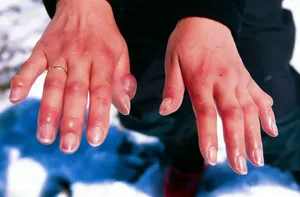 علائم سرمازدگی اعضای بدن از زبان مدرس امداد و نجات (فیلم)