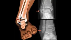 راهنمای نجات جان مصدوم؛ کمک‌های اولیه «شکستگی» در شرایط جنگی و بحران/ آتل‌بندی به روش صحیح و ساده