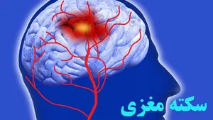 سبقت مردان از زنان در سکته مغزی